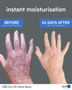 An image comparing a ladies hand before using the dry oil hand spray. And then 24 days after using the dry oil hand spray.